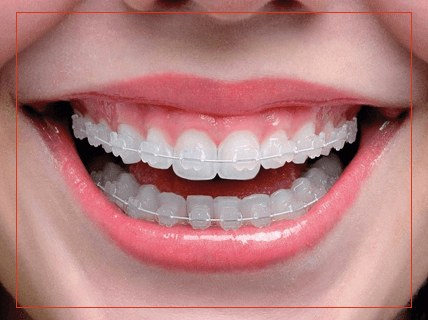 aparelho dentário Iso Clínica